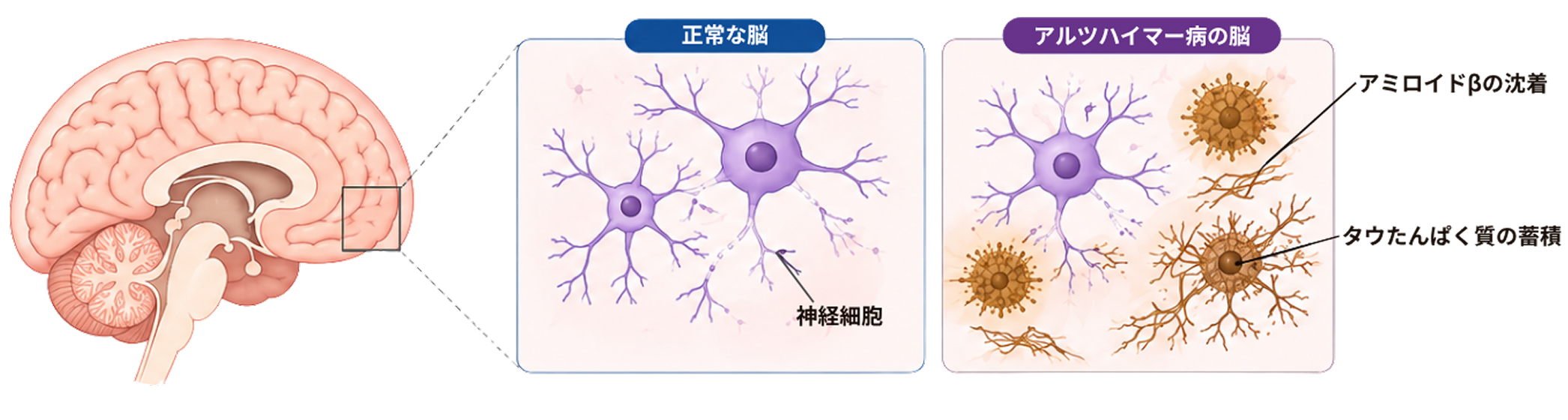 血管内にステントが挿入された動脈のイメージ図