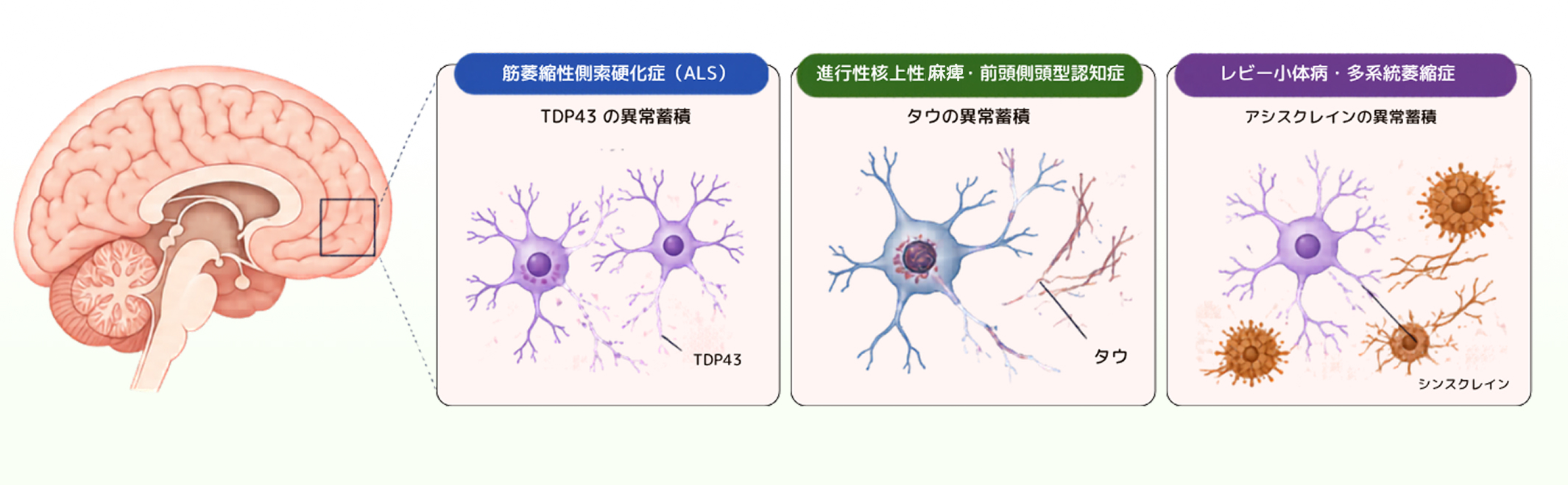 神経変性疾患ごとの異常タンパク質の蓄積を示す模式図